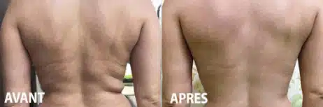 Coolwaves avant après