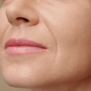 Femme avec des sillons nasogéniens envisageant des injections d’acide hyaluronique chez un médecin esthétique à Paris, Docteur Dominique Bellecour