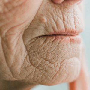 Femme avec des rides “code-barres” envisageant des injections d’acide hyaluronique chez un médecin esthétique à Paris, Docteur Dominique Bellecour