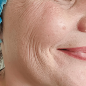 Femme avec des plis d’amertume envisageant des injections d’acide hyaluronique , radiofréquence microneedling chez un médecin esthétique à Paris, Docteur Dominique Bellecour