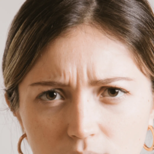 Injections d’acide hyaluronique pour les rides du lion réalisées par un médecin esthétique à Paris, Docteur Dominique Bellecour