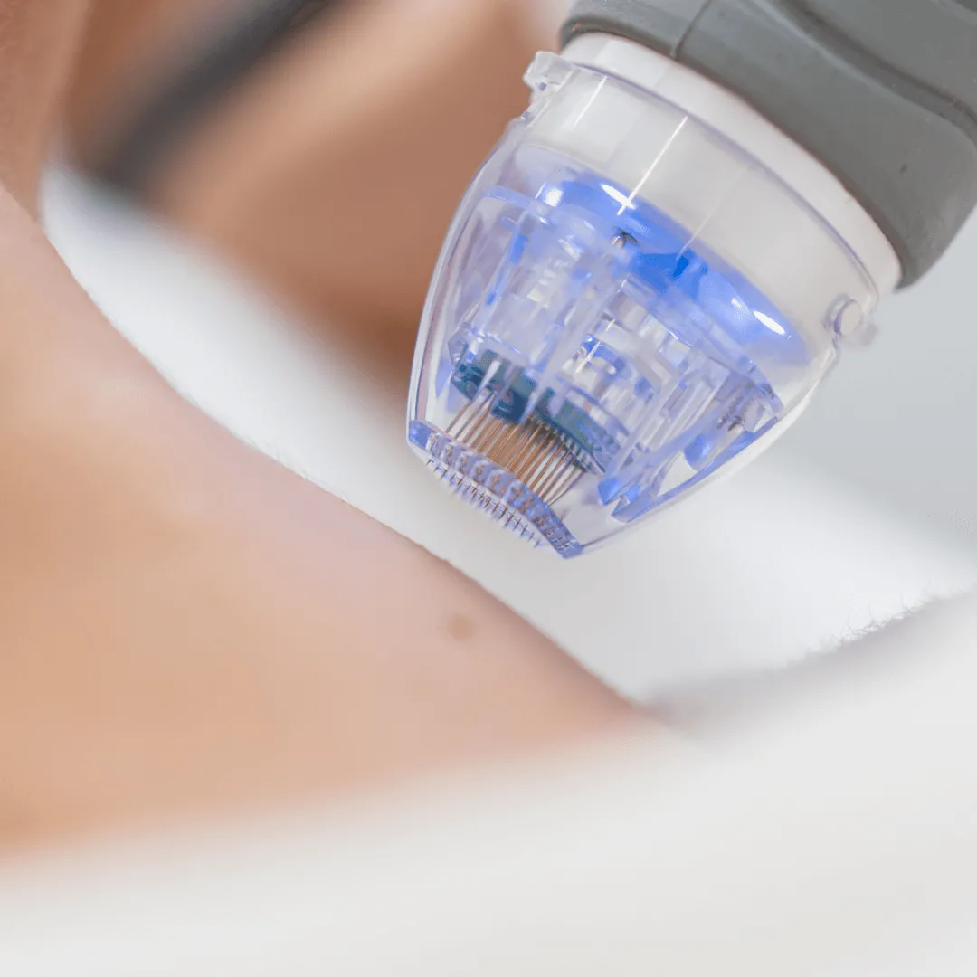 La radiofréquence microneedling