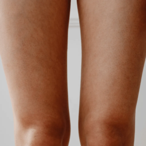 Femme souhaitant Coolwaves jambes soins esthétiques Paris médecin esthétique Paris Docteur Dominique Bellecour