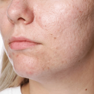 Femme cicatrices acné radiofréquence microneedling soins esthétiques Paris médecin esthétique Paris Docteur Dominique Bellecour