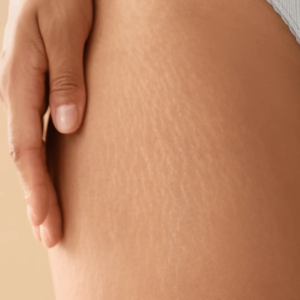 Femme vergetures radiofréquence microneedling soins esthétiques Paris médecin esthétique Paris Docteur Dominique Bellecour