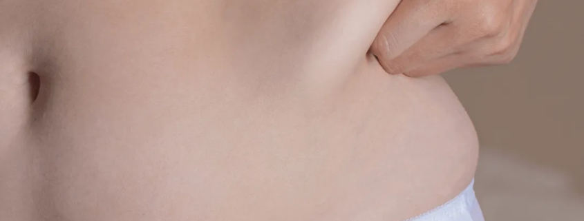 Femme souhaitant cryolipolyse poignées d amour soins esthétiques Paris médecin esthétique Paris Docteur Dominique Bellecour