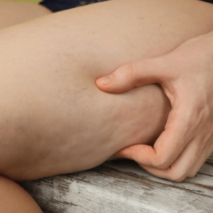 Femme souhaitant Coolwaves culotte de cheval soins esthétiques Paris médecin esthétique Paris Docteur Dominique Bellecour