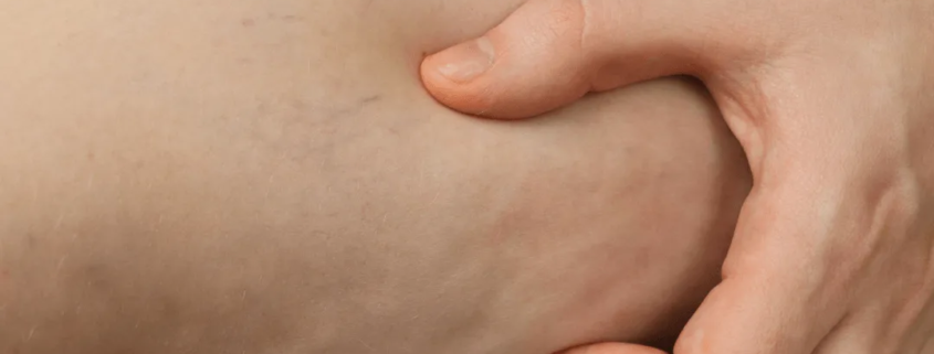 Femme souhaitant Coolwaves culotte de cheval soins esthétiques Paris médecin esthétique Paris Docteur Dominique Bellecour