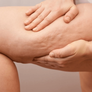 Femme souhaitant cryolipolyse culotte de cheval soins esthétiques Paris médecin esthétique Paris Docteur Dominique Bellecour