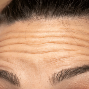 Femme avec des rides sur le front envisageant des injections d’acide hyaluronique chez un médecin esthétique à Paris, Docteur Dominique Bellecour