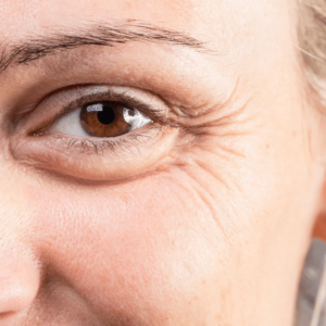 Femme avec des pattes d’oie envisageant des injections d’acide hyaluronique chez un médecin esthétique à Paris, Docteur Dominique Bellecour