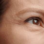 Femme rides souhaitant laser CO2 soins esthétiques Paris docteur esthétique Paris Dominique Bellecour