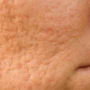 Femme cicatrices acné laser CO2 soins esthétiques Paris docteur esthétique Paris Dominique Bellecour