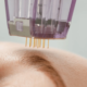 Traitement microneedling radiofréquence rides solutions efficaces docteur médecin esthétique Paris Dominique Bellecour