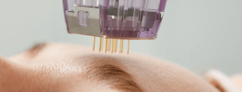 Traitement microneedling radiofréquence rides solutions efficaces docteur médecin esthétique Paris Dominique Bellecour