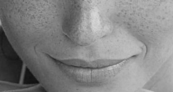 Gros plan sur la peau du visage, illustration du microneedling par radiofréquence